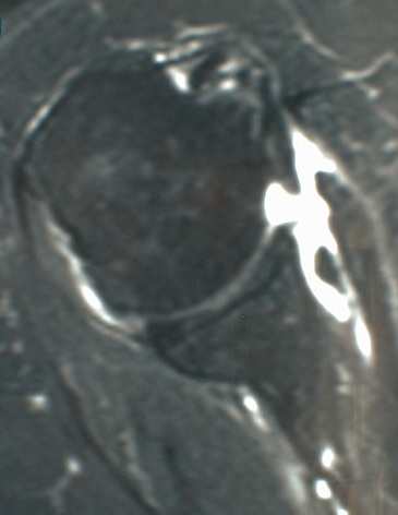 rupture du tendon sub-scapulaire
