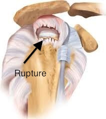 Rupture de la coiffe des rotateurs