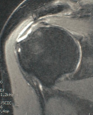 ruptures de coiffe