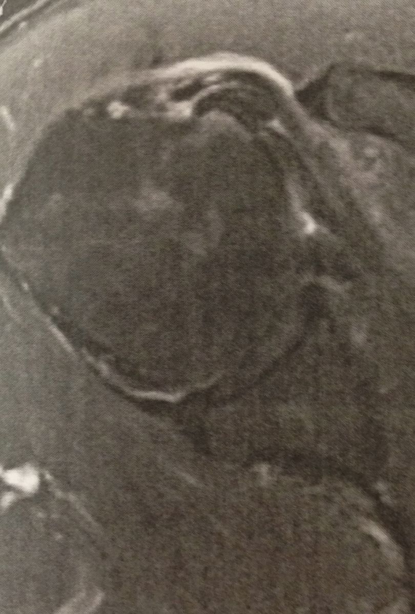 Tendinopathie du long biceps