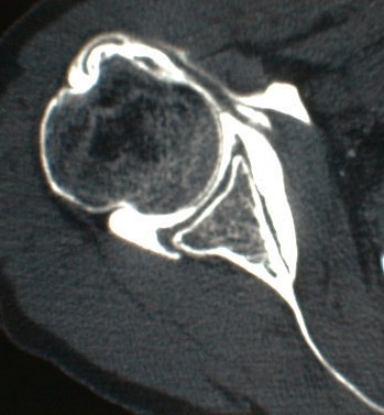 Tendinopathie du long biceps
